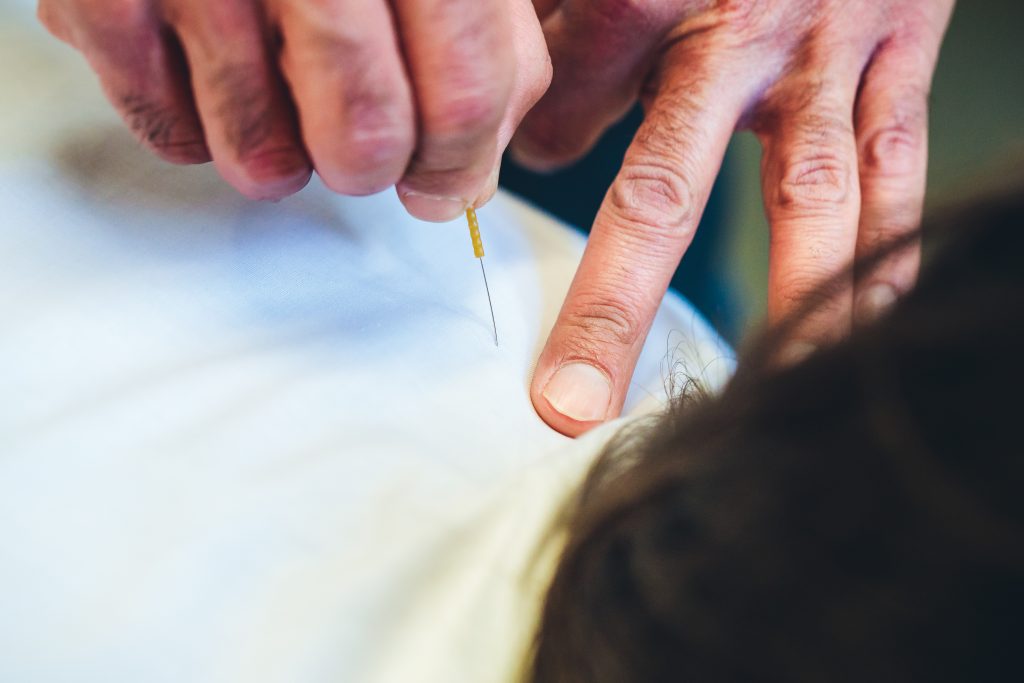 Acupuncture In Southend On Sea Essex
